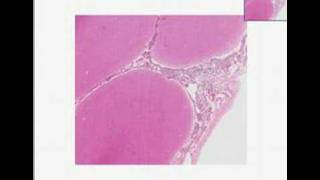 Histopathology Brain Acute pyogenic bacterial meningitis [upl. by Gracye]