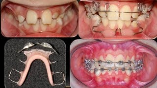 Removable Orthodontic Appliances Orthodontist [upl. by Ladew]