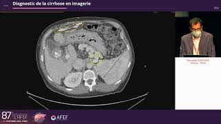 Diagnostic de la cirrhose en imagerie  R Sartoris [upl. by Osher565]