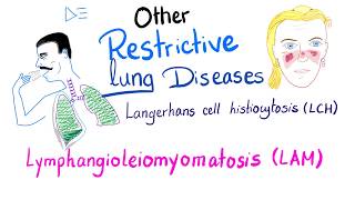 Langerhans cell Histiocytosis LCH and Lymphangioleiomyomatosis LAM  Respiratory Pathology [upl. by Yllor]