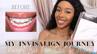 MY INVISALIGN JOURNEY  WEIGHT LOSS COST PAIN AND THE PROCESS [upl. by Rana]