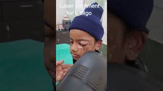 Laser treatment for Vitiligo leucoderma dermatologistadvice laserclinic skincare [upl. by Griggs]