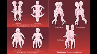 Types of conjoined conjoint twins  Omphalopagus Pygopagus Craniopagus Diprosopus Parapagus [upl. by Coridon248]