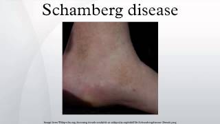 Schamberg disease [upl. by Siskind]