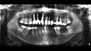 für Zahnärzte das OPTG Röntgen [upl. by Fong]