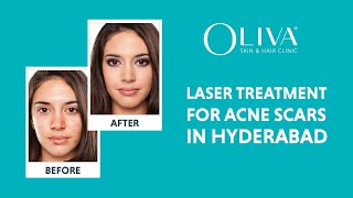 Laser Treatment For Acne Scars In Hyderabad – Dermatologists For Pimple Marks [upl. by Theurer702]