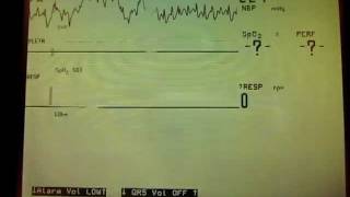 Asystole Apnea alarms [upl. by Ayak715]