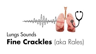 Fine Crackles Rales  Lung Sounds  MEDZCOOL [upl. by Yedrahs336]