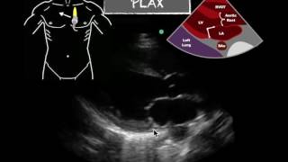 POCUS PLAX Severely Reduced EF [upl. by Domenic356]