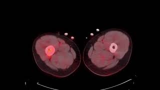 MSK Tumor C9 LCH PET CT [upl. by Ennaillek]