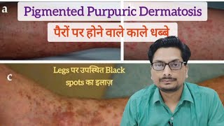 पैरों पर होने वाले काले धब्बे  Legs पर उपस्थित Black spots का इलाज़  Pigmented Purpuric Dermatosis [upl. by Adnama]