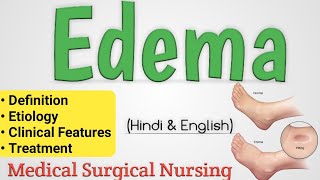 Edema  Edema In Hindi  Oedema [upl. by Nnairet646]