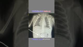 Pediatrics chest x ray doctor xraytechnicians radiology support ytshorts sidhi [upl. by Nayhr]