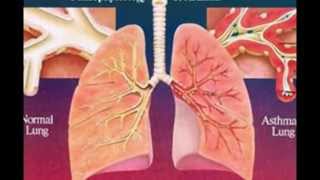 Pathophysiology of asthma [upl. by Craw394]