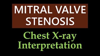 Mitral Valve Stenosis  Chest Xray Interpretation [upl. by Melli]