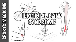 Iliotibial Band Syndrome ITBS  Overview [upl. by Gilboa]