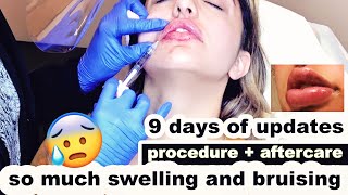 LIP FILLERS  First time tips for faster healing [upl. by Ebocaj602]