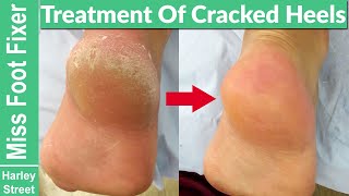 Satisfying callus heel foot scraping  cracked heels  Fissures Foot fixer Marion Yau [upl. by Marv320]