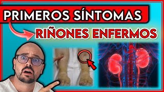 ESTOS son los 9 PRIMEROS SÍNTOMAS de unos RIÑONES ENFERMOS  Indican INSUFICIENCIA RENAL [upl. by Ball796]