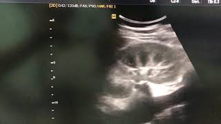 Medical renal disease  Loss of corticomedullary differentiation [upl. by Eynaffit]