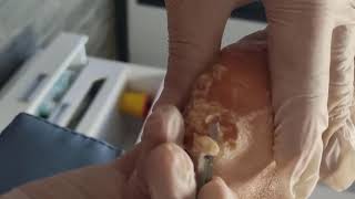 Removing Extremely Hard Foot Callus 🦶 The right way to remove foot callus FULL TREATMENT 10 [upl. by Schear]