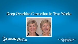 Deep Overbite Correction in Two Weeks [upl. by Servetnick]