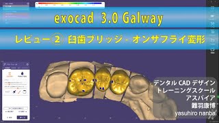 exocad 30 Galway レビュー ② 臼歯ブリッジオンザフライ変形 [upl. by Florenza284]