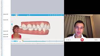 Clincheck review to solve crossbite with Invisalign [upl. by Veal]