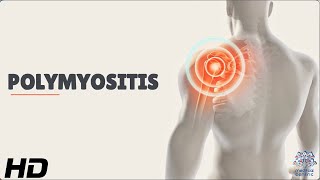 Polymyositis Understanding the Rare Autoimmune Disease [upl. by Nolrak846]