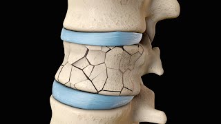 Back Surgery  Vertebroplasty and Kyphoplasty  Nucleus Health [upl. by Hatch]