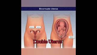 Double UterusDouble Cervix medicalimaging [upl. by Imoan25]