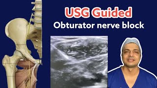 USG Guided Obturator Nerve Block  Real USG Video  Obturator Nerve Anatomy and Course [upl. by Adnawahs397]