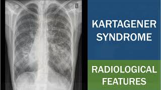 Kartagener Syndrome  Primary Ciliary Dyskinesia  Situs Inversus  Chest Xray [upl. by Chrisman]