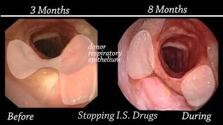 Endoscopic Evaluation of the Tracheal Allotransplant [upl. by Maibach]