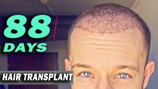 FUE Hair Transplant DAY 88 post op Turkey Istanbul GROWTH STAGE [upl. by Yrneh]