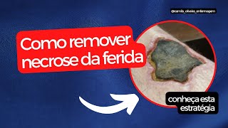 Como remover a necrose coagulativa na ferida [upl. by Dante529]