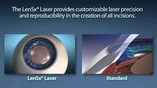 Laserassisted cataract surgery vs traditional cataract surgery [upl. by Nnylakcaj]