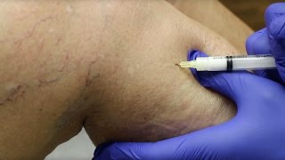 Sclerotherapy Varicose Veins Treatment [upl. by Idyak694]