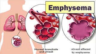 Emphysema I Causes Symptoms Prevention amp Treatment [upl. by Ahsad244]