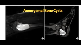 Aneurysmal Bone Cyst [upl. by Ma]