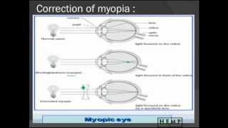 errors of refraction pt 4 [upl. by Neisa]