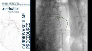 Inferior Mesenteric Artery Embolization Lumsden MD Auyang MD Ponraj Chinnadurai [upl. by Retxed]