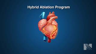 Atrial Fibrillation Treatment Hybrid Atrial Fibrillation AF Ablation [upl. by Sparke]