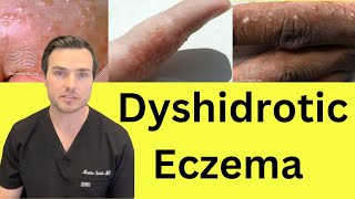 What is Dyshidrotic hand Eczema Causes and treatment [upl. by Ahsad]