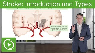 Stroke Introduction and Types  Clinical Neurology [upl. by Anoj702]