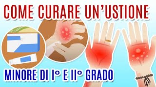 COME CURARE LE USTIONI [upl. by Garold]