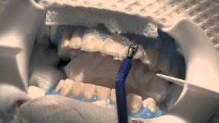 InOffice ToothWhitening [upl. by Mckinney]