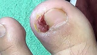 Ep5914 Ingrown toenail removal 👣 คุณแม่ใส่ยาอะไรคะ 😁 clip from Thailand [upl. by Lehman]