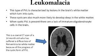 Periventricular Leukomalacia [upl. by Chet]