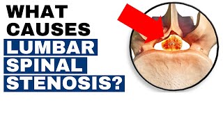 What Are The Main Causes Of Spinal Stenosis LUMBAR SPINAL STENOSIS  Dr John Zielonka [upl. by Jasik]